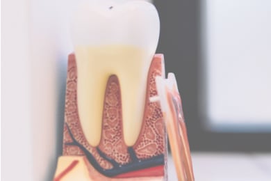 ¿Cuándo es necesario realizar endodoncias?