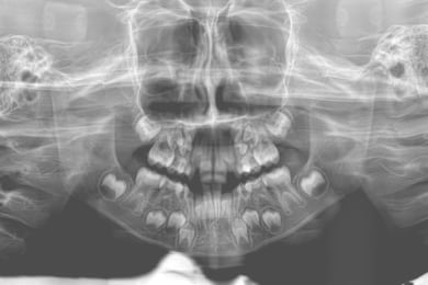 radiografia de dientes de leche