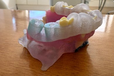 Férula de cirugía guiada de implantes dentales